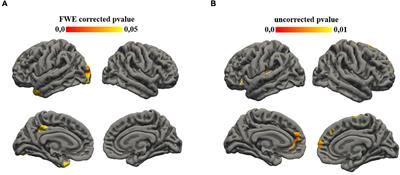 Cortical Thickness and Clinical Findings in Prescholar Children With Autism Spectrum Disorder